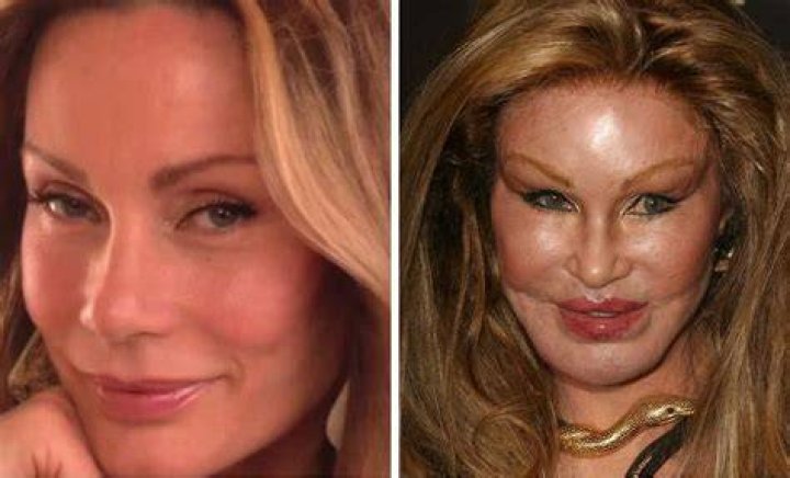 Bad Celebrity Plastic Surgery, Face Plastic Surgery, Bad Plastic