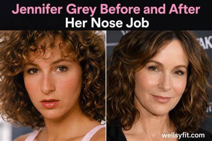 Before And After Her Nose Job