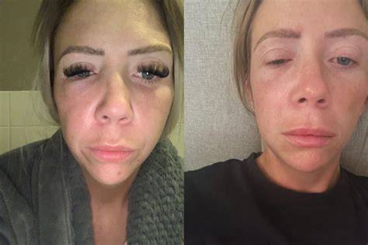 Botox Gone Wrong! Woman's Lips Left Swollen After Getting Fillers From