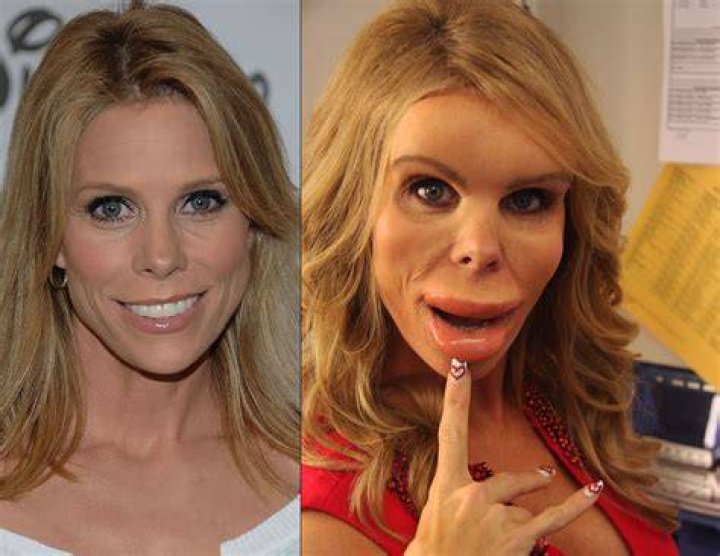 Botox Injection gone wrong on Cheryl Hinds for 'Suburgatory