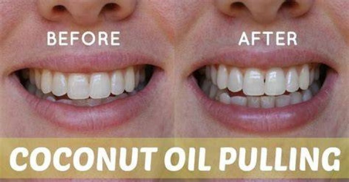 Coconut Oil for Teeth Whitening coconutoilforhealthyhair Coconut Oil