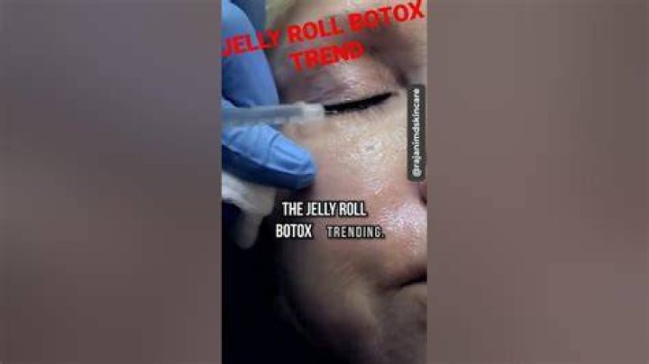 Jelly Roll Botox YouTube