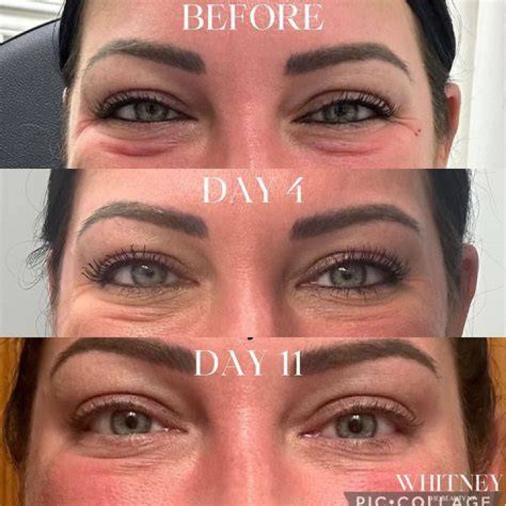 Jelly Rolls Botox in the Under Eye YouTube