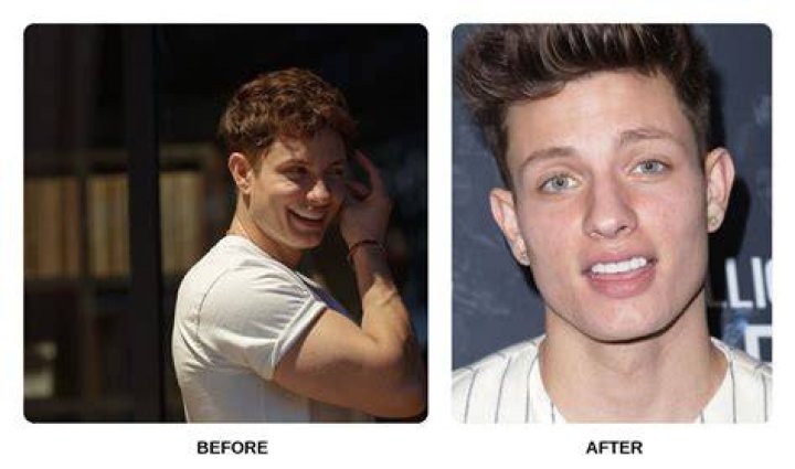 Matt Rife Before Fixing His Teeth The Wild ‘n Out Star’s Glow Up Examined!