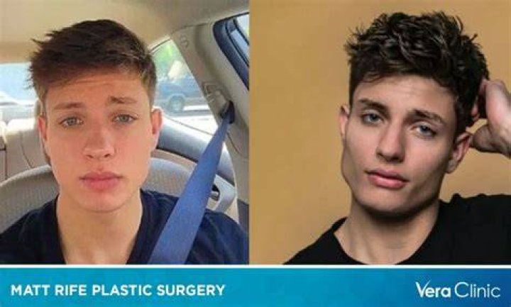 Matt Rife&rsquo;s Plastic Surgery Check Out His Before and After Pictures
