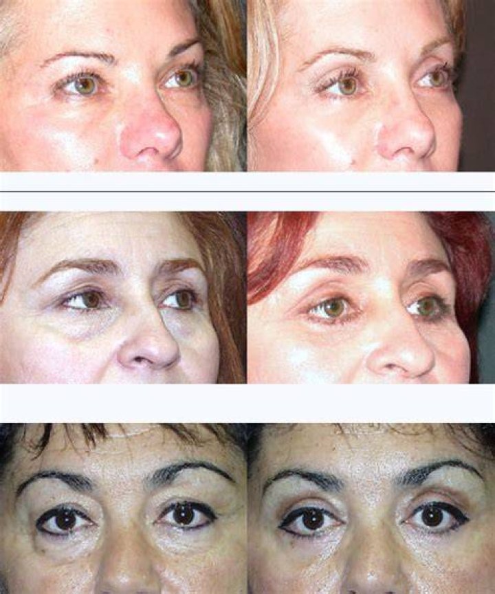 NonSurgical Blepharoplasty for Droopy and Hooded Eyelids