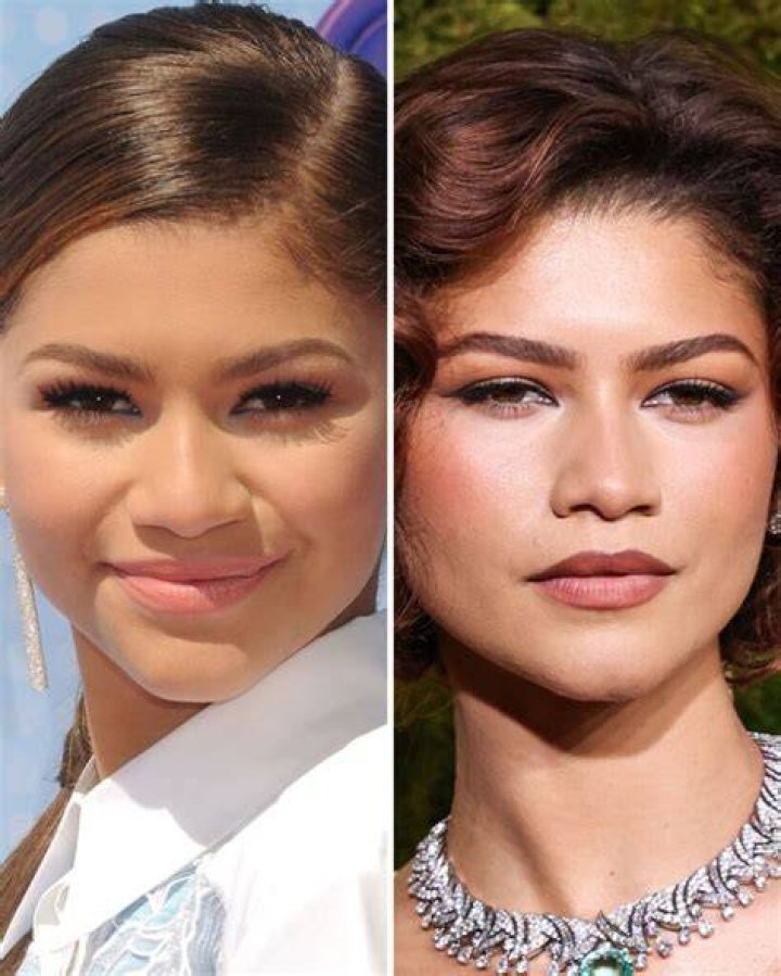 Unveiling Zendaya's Plastic Surgery: Discoveries And Insights