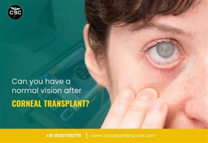 Vision after corneal transplant? r/Keratoconus
