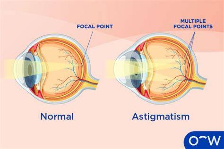 What is an Astigmatism in the Eye? Health Life Media