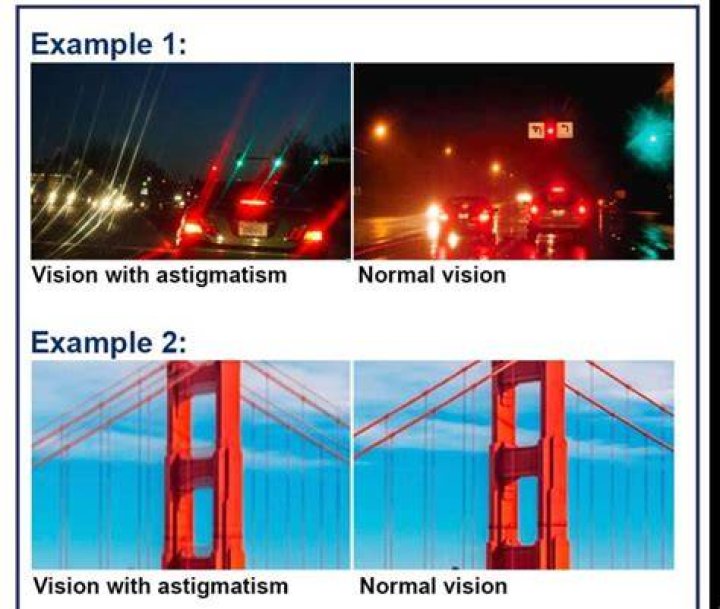WHAT IS ASTIGMATISM ? Cypress Eye Centre