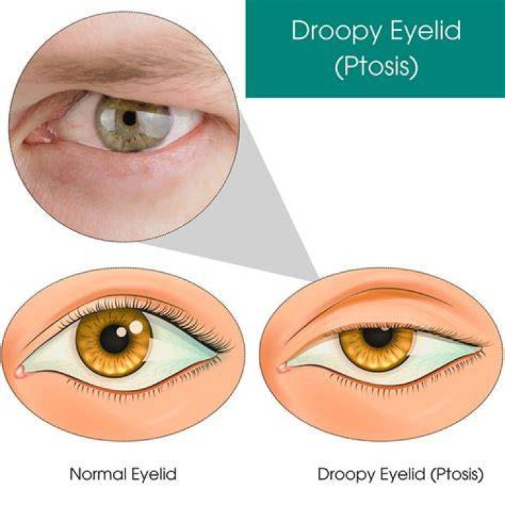 What Lurks Behind Ken Paxton's Droopy Eyelid