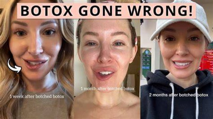 When Botox Goes Wrong YouTube